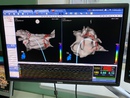 Электрофизиологическая навигационная система Columbus 3D от компании MicroPort Electrophysiology